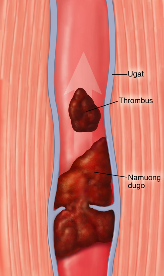 Ugat na may pamumuo ng dugo at embolus sa loob. Kabilang sa mga label ang: Ugat, Thrombus, at Namuong Dugo.