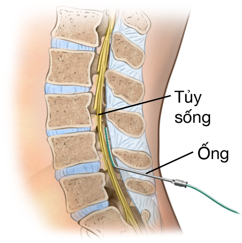 Phần cắt ngang nhìn bên cạnh của phần dưới cột sống cho thấy cột sống và các dây thần kinh cột sống trong rãnh cột sống. Ống thông được nhét vào trong da giữa hai đốt sống và vào rãnh cột sống. Ống thông không vào túi nhỏ bao xung quanh các dây thần kinh cột sống.