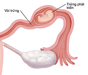 Mặt cắt ngang của ống dẫn trứng với phôi phát triển bên trong thai ngoài tử cung.