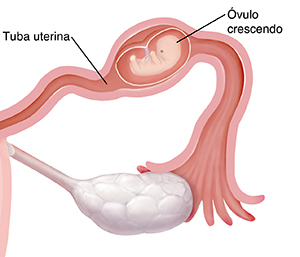 Vista aproximada da seção transversal da tuba uterina com embrião crescendo dentro na gravidez ectópica.