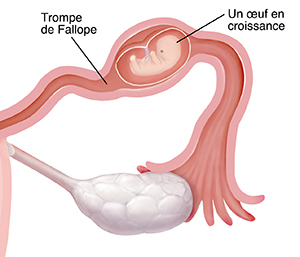 Coupe transversale en gros plan d'une trompe de Fallope où un embryon se développe à l'intérieur dans le cadre d'une grossesse extra-utérine.