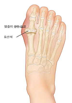 통풍 염증과 요산석이 생긴 발의 뼈가 보이는 발의 상면도.