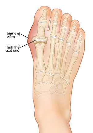 Nhìn từ trên xuống của bàn chân cho thấy xương bàn chân bị viêm do bệnh gout và các tinh thể axit uric.