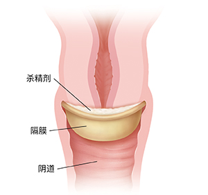 子宫颈放置有杀精剂的隔膜。