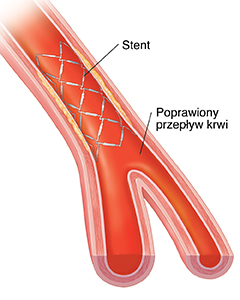Przekrój tętnicy pokazujący przepływ krwi przez stent.